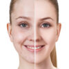 Pacchetto anti acne