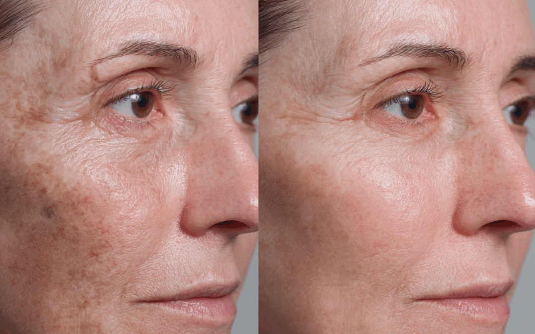 Microneedling, sieri e peeling per il trattamento del melasma